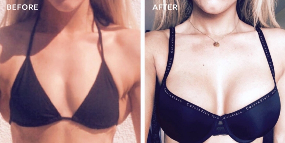 breast-augmentation-before-after